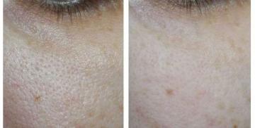 Vis og fortælle, hvordan injektionsmørtel for porer på huden 50+